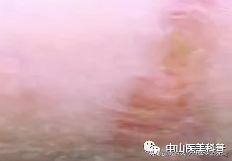 疤痕祛除咨询,一些疤痕的治疗效果图