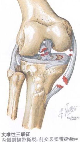 膝关节半月板损伤的相关知识,膝关节软骨损伤科普