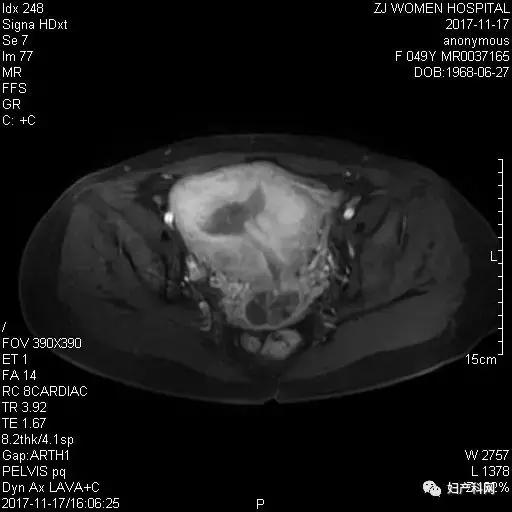异常子宫出血诊断与治疗最新文献,围绝经期异常子宫出血病例分享