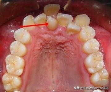 儿童牙齿错位是什么原因导致的,儿童牙齿错位了怎么办