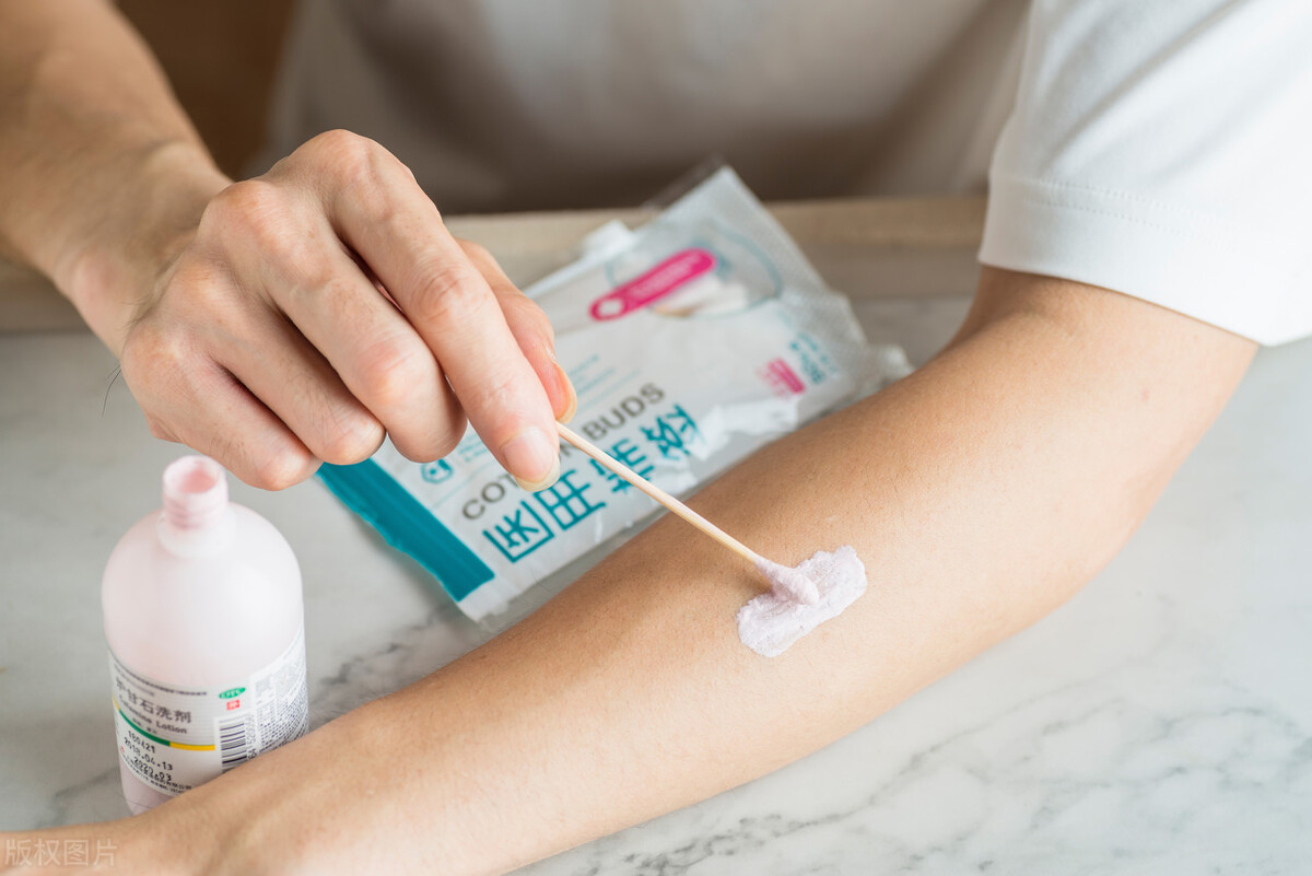 得了麻疹特别痒不管没事吧,得了麻疹特别痒没治不伤筋不动骨