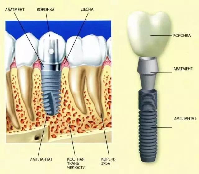 种植牙是什么成分,种植牙是什么英文