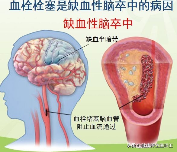 生命健康有哪些方面,临床症状脑血栓形成