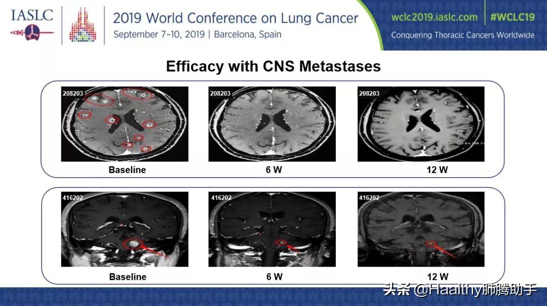 厉害了，中国智造！国产抗癌药物集体亮相世界肺癌大会