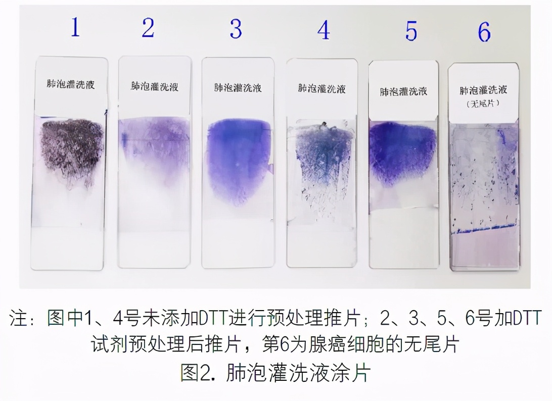 支气管肺泡灌洗液检测技术规范,肺泡灌洗液肿瘤细胞检查准确性