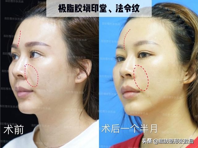 为什么我笑起来有皱纹,为什么我笑起来很显老