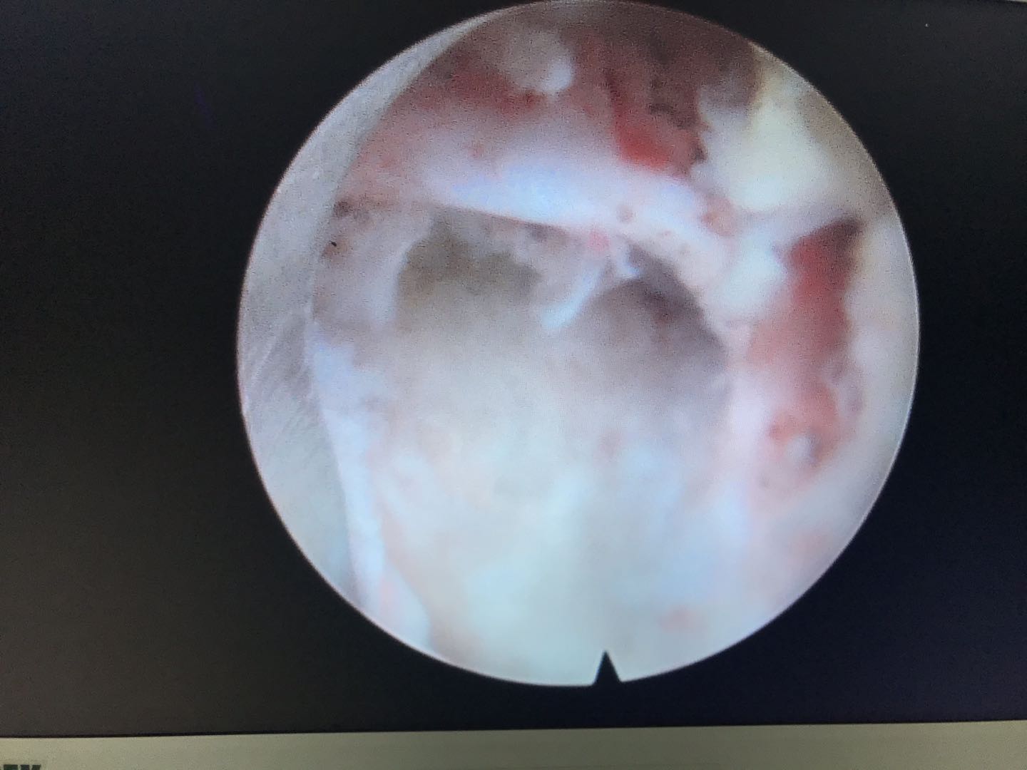 腰椎微创手术危险吗,腰椎微创手术有风险吗