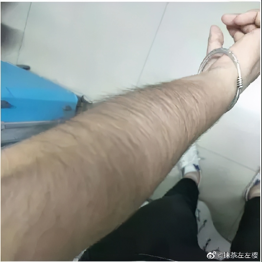 妇科体毛少怎么办,女生体毛比男生多是什么原因