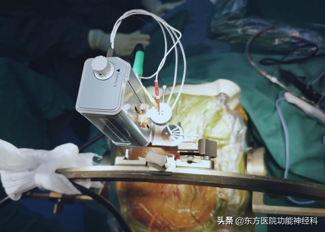 抽动秽语症手术治疗成年人,抽动秽语综合征治疗的研究