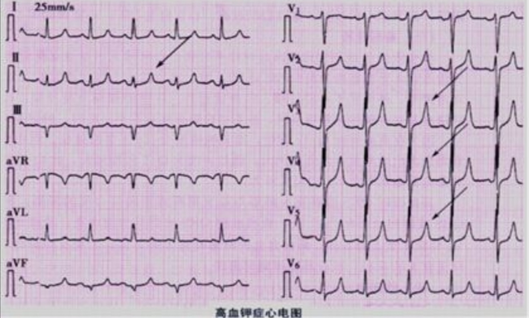 高钾血症的表现,高钾血症紧急处理