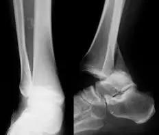 几种严重骨折医学名称,常见的骨折有哪些名称