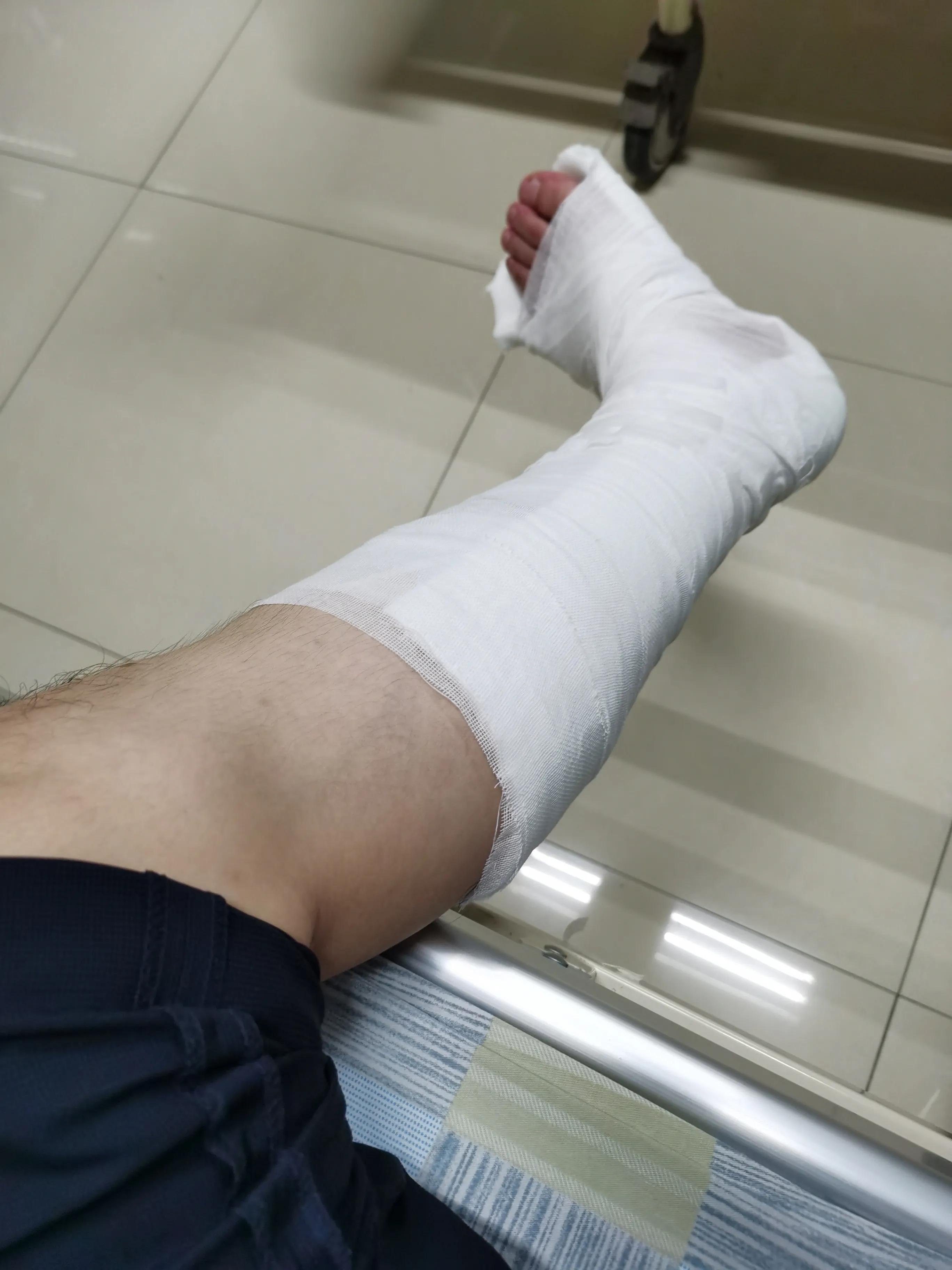 第五跖骨基底部骨折60天能走路吗,第五跖骨基底部骨折60天能脱拐吗