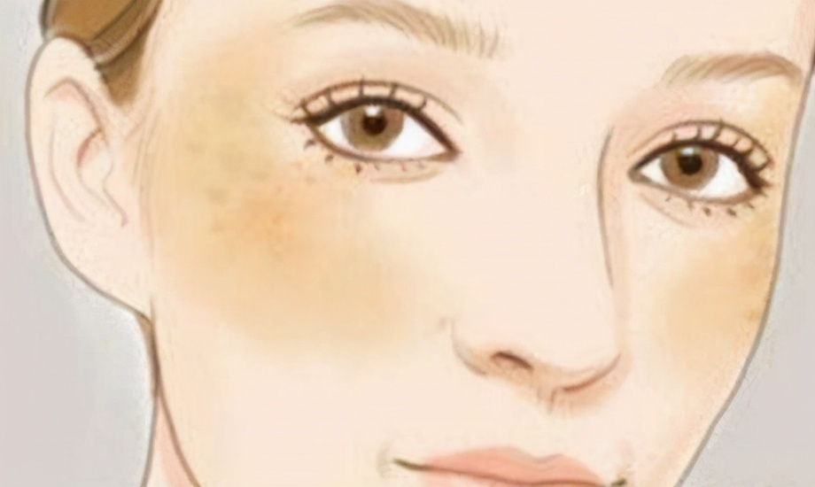 脸色暗沉黄褐斑如何调理,黄褐斑内调10种方法桃红四物汤