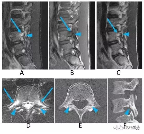 9种椎体和椎旁信号增高的非肿瘤性病变