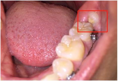 智齿冠周炎剧痛怎么缓解疼痛,智齿冠周炎急性怎么缓解疼痛