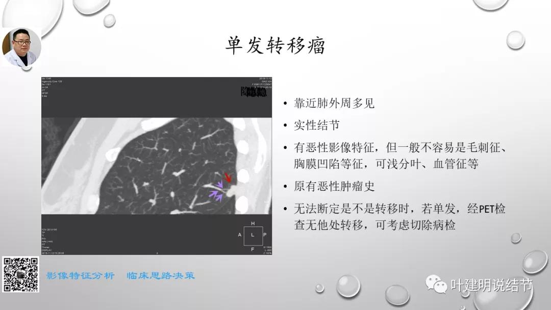 叶建明谈肺实性小结节视频,廖正银教授谈肺结节