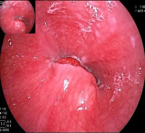 贲门隆起性病变影像,贲门溃疡隆起性病变