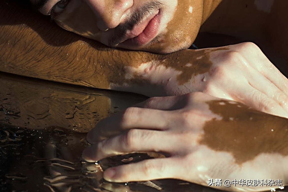 治疗白癜风注意事项都有哪些呢,预防白癜风的十大禁忌