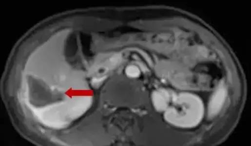 直肠癌病例分享,直肠癌肝转移做射频消融动画演示