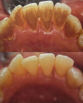 牙黄牙齿贴面全过程,哪里可以贴面修复黄牙