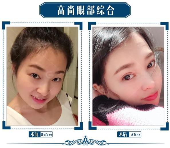 割双眼皮对面相有改变吗,割双眼皮对面相好吗