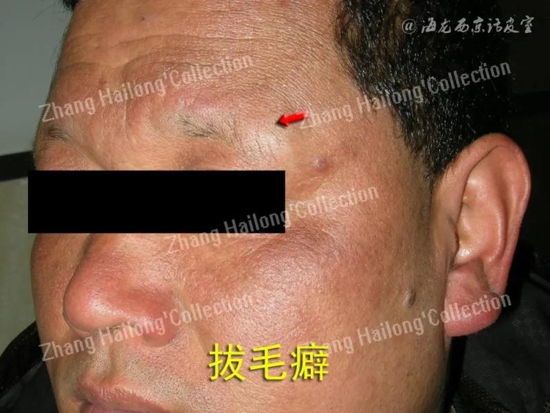 拔毛癖是因为压力吗,拔毛癖是心理问题吗