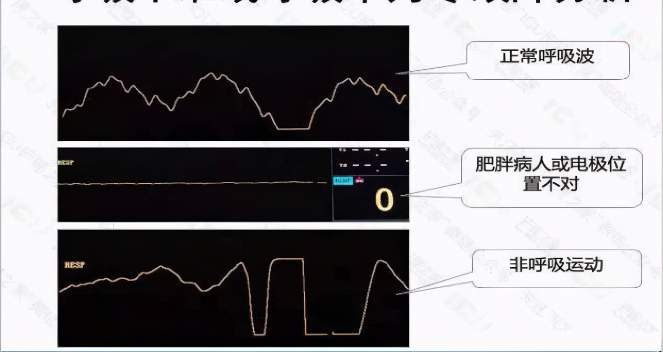 心电监护使用ppt,心电监护使用时间计算