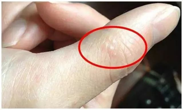 一到夏天，手上就长小水疱？汗疱疹别挑破，艾灸止痒防复发
