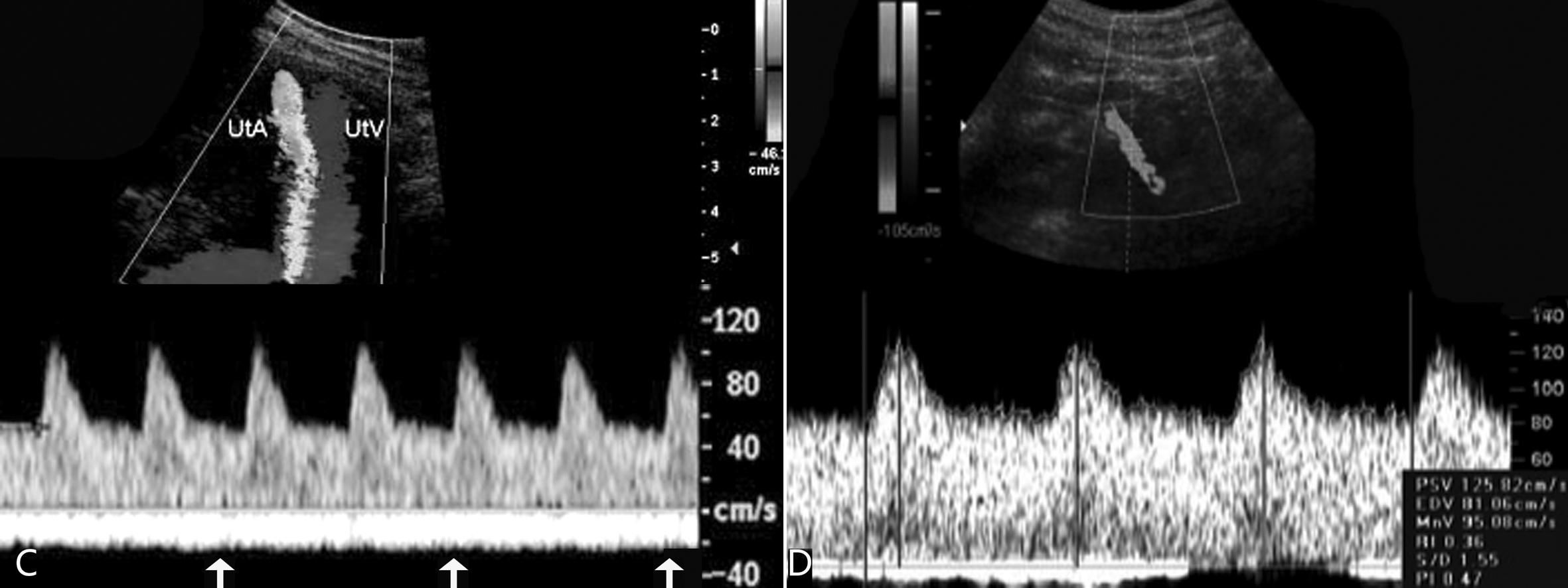 明明白白做超声23-2：妊娠期子宫及卵巢超声多普勒检查