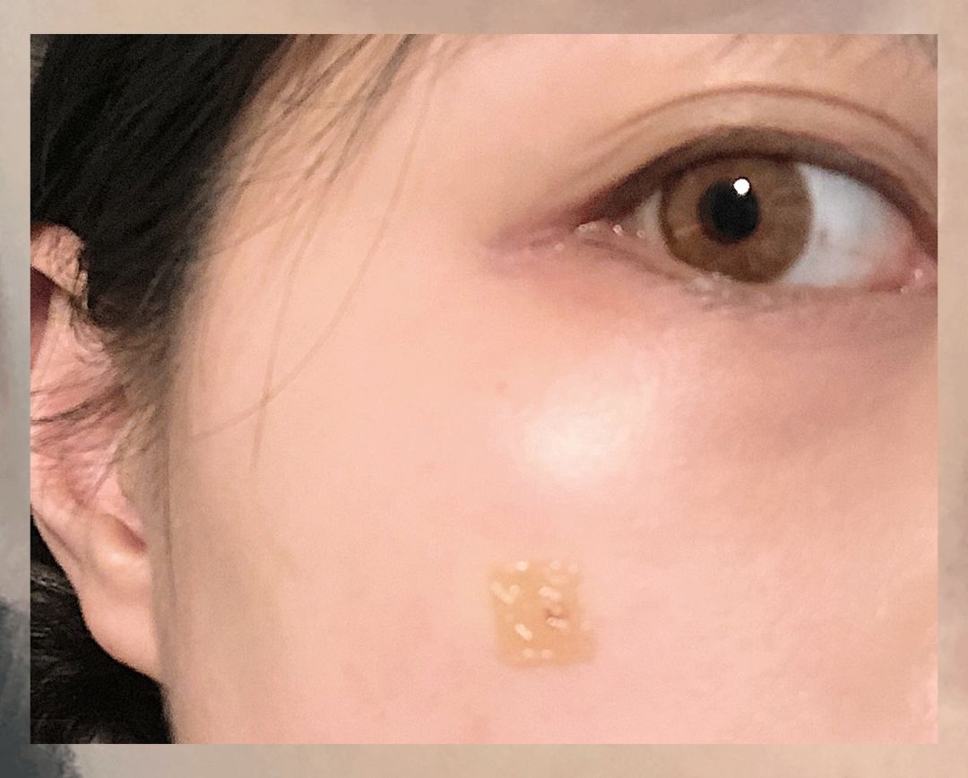 一次就能让黑眼圈消失的办法,一针下去瞬间没了黑眼圈