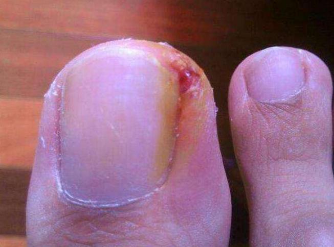 甲沟炎，灰指甲和脚气都有什么症状，该怎么治疗？