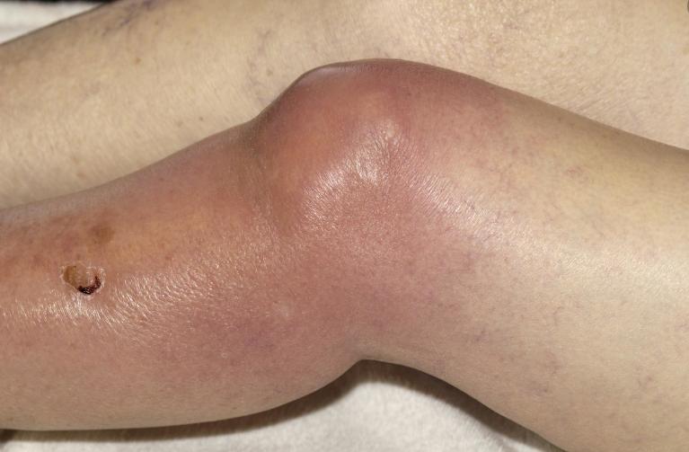 膝关节滑膜炎肿胀积水原因,膝关节滑膜炎积水了肿胀怎么办