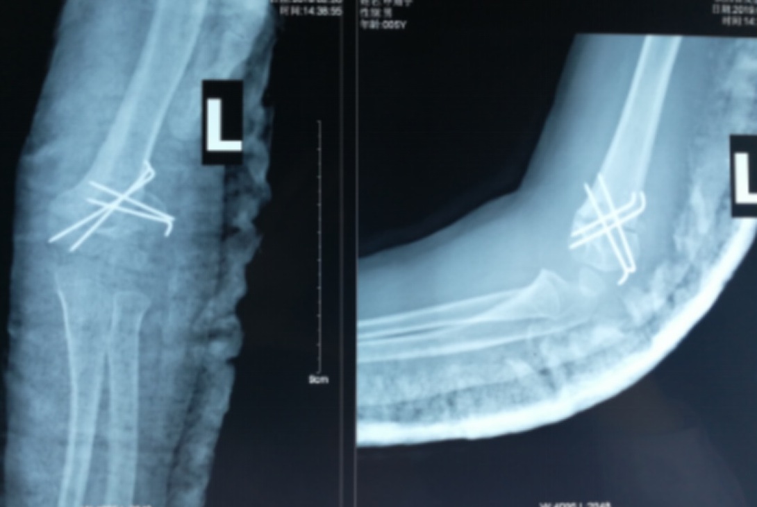 肘关节骨折出现的后遗症,肘关节陈旧性骨折肘内翻