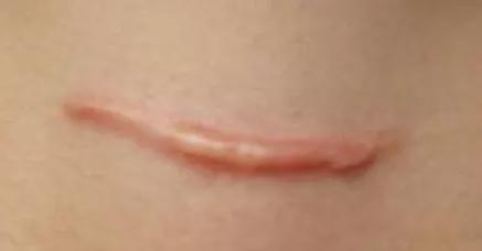 剖腹产的疤痕增生怎么除疤,疤痕体质如何才能正确除疤