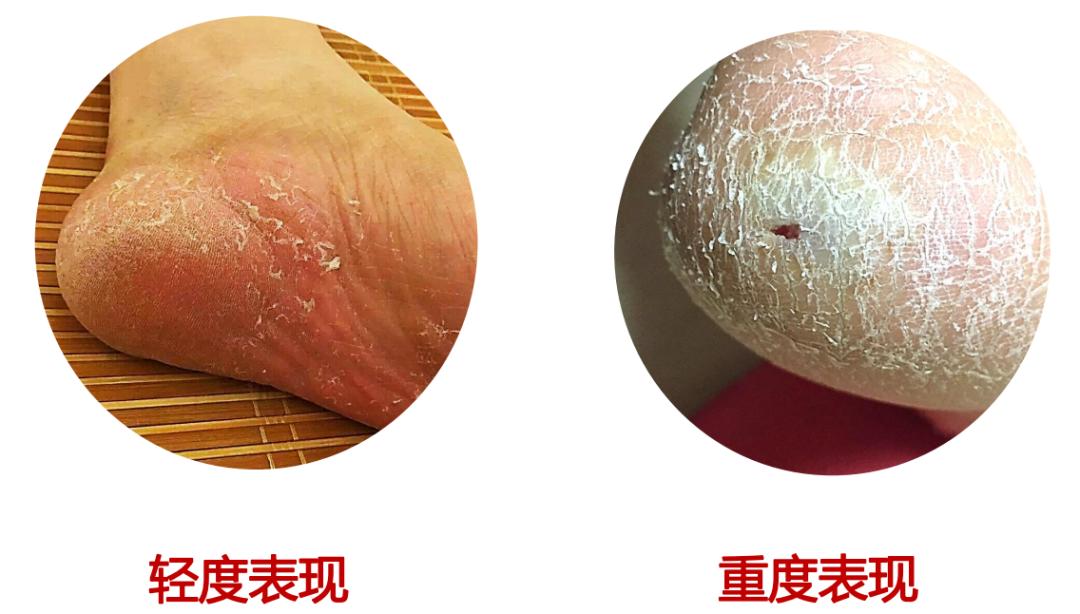 及时治疗脚气,是对家人最好的负责