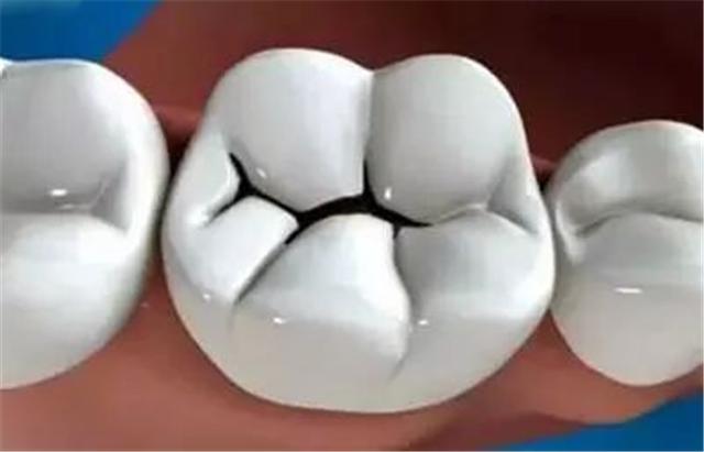 牙齿上有黑色斑点刷也刷不掉,牙齿上有黑线但是不痛