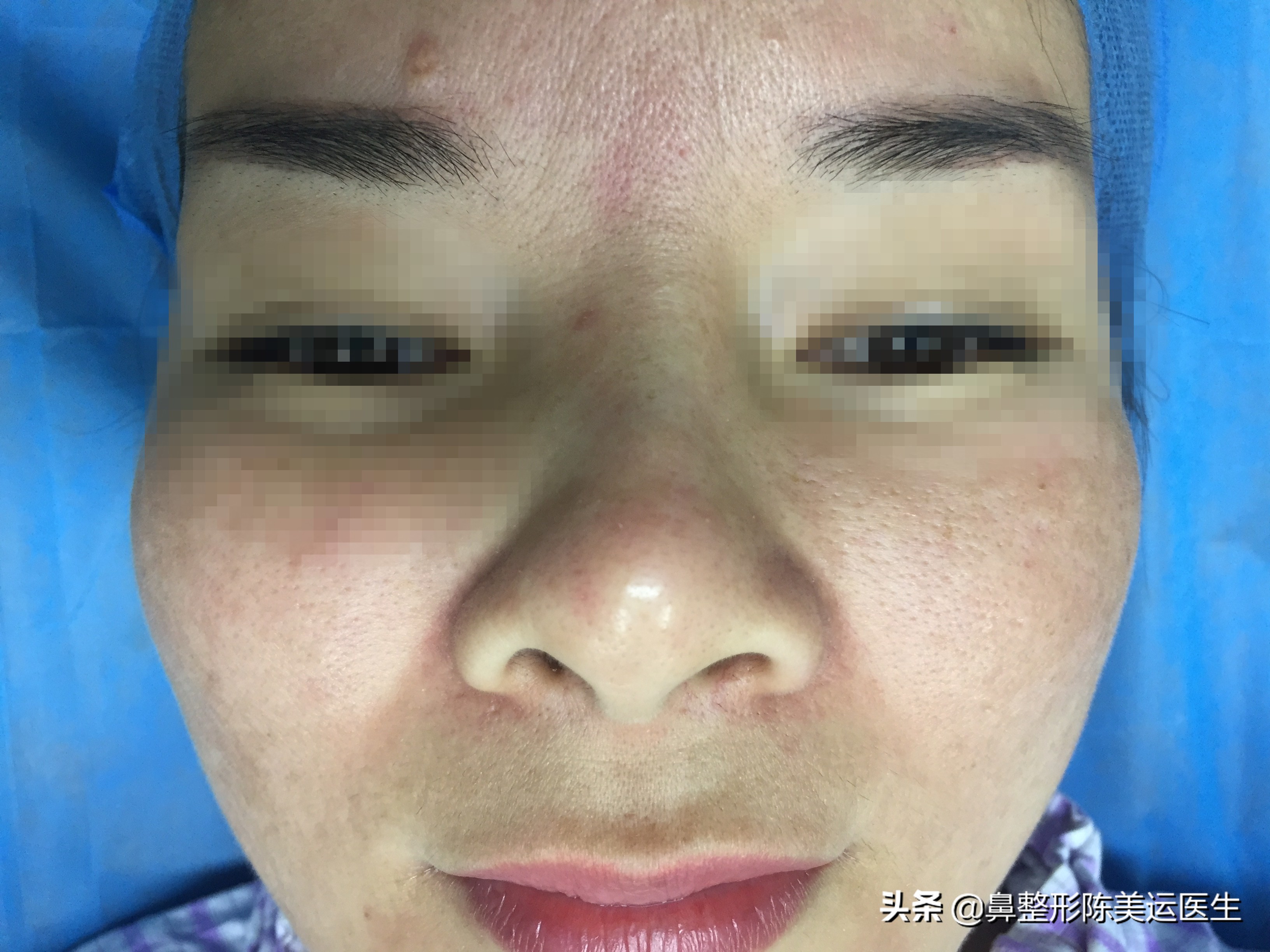 假体隆鼻后鼻子变歪该如何处理,假体隆鼻透光如何处理