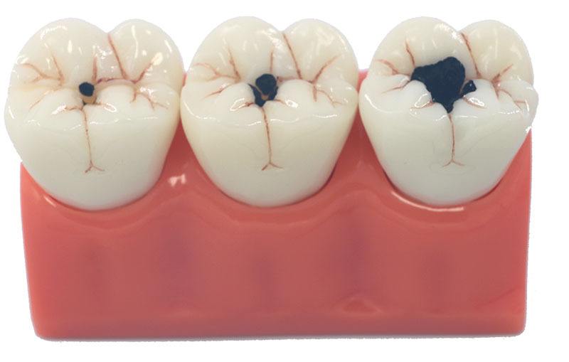 牙齿龋坏补牙能维持多久,牙齿龋坏比较严重补牙效果好吗