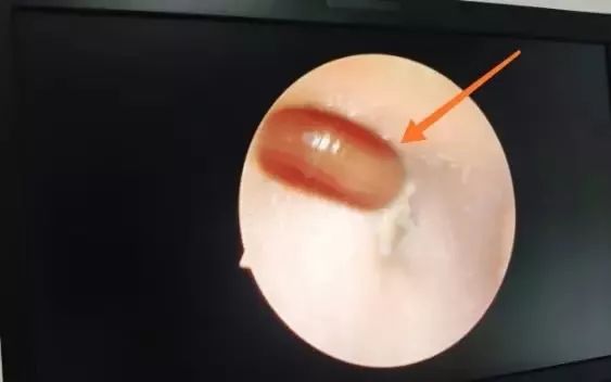 七岁小孩耳朵前面长小米粒,7岁小孩耳朵里有虫