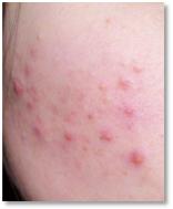 你为什么会长痘痘应该怎么治,为什么你会长痘