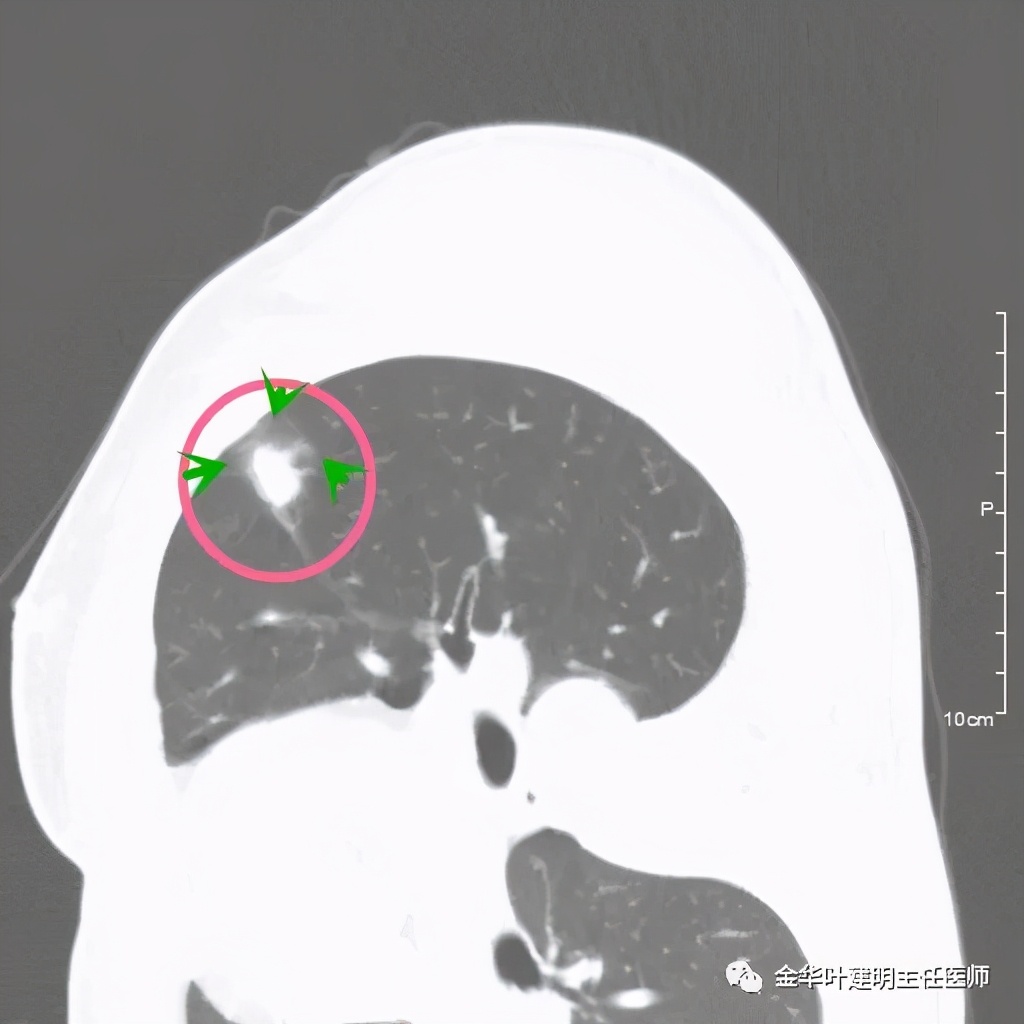 叶建明谈肺结节:一招分辨隐球菌性肉芽肿与肺癌
