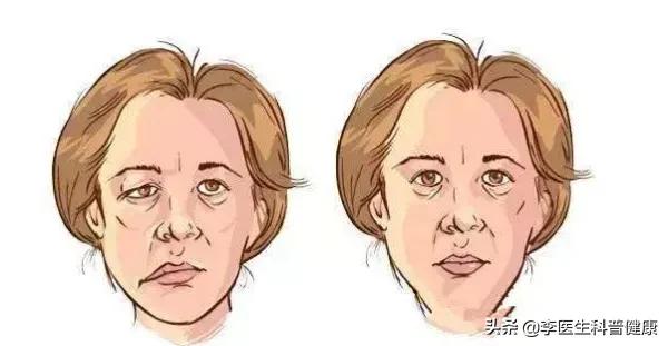 面部吹点冷风,发现眼睛闭不上了,嘴巴也歪了,到底是咋回事儿?