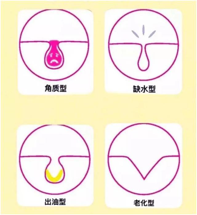 皮肤粗糙毛孔粗大自愈,毛孔粗大毛孔里都是白的