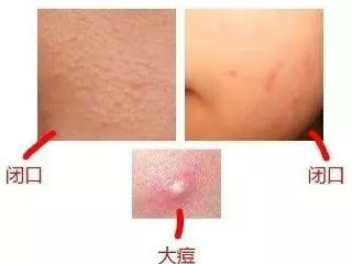 后背长闭合性粉刺怎么办,下巴长闭合性粉刺怎么去除
