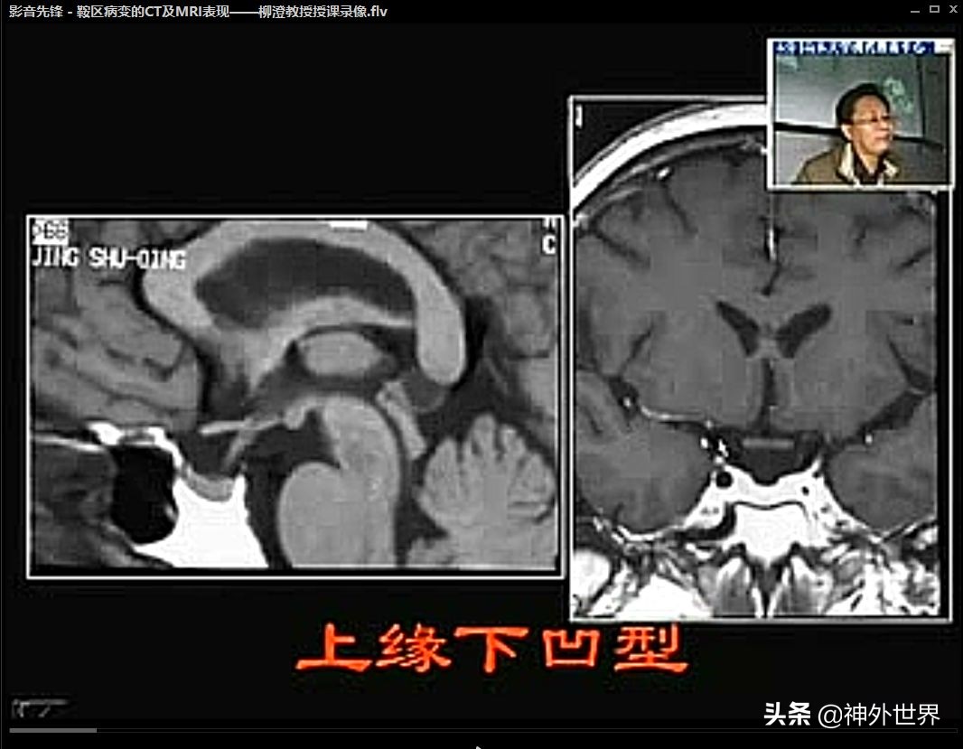 鞍区解剖学习笔记之——垂体