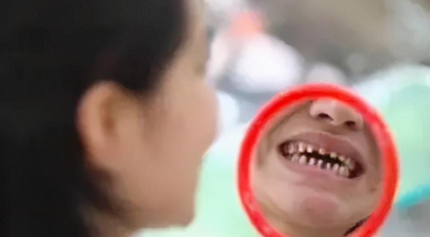 赵薇牙齿做了烤瓷牙吗,吴宣仪牙齿烤瓷牙