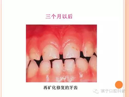 有牙洞用含氟牙膏,牙齿涂氟小知识