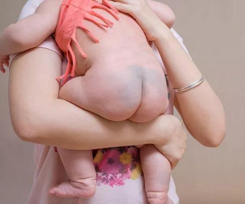 宝宝屁股上淤青怎么回事,宝宝屁股的淤青什么时候会消