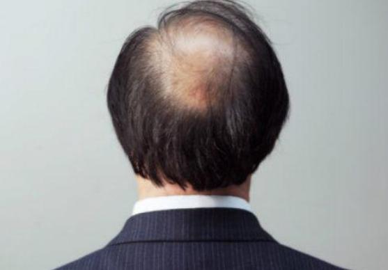 从根源解决头皮毛发的所有问题,从毛囊萎缩到长头发需要多久