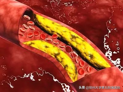 腿梗严重吗,为什么有的人脑梗心梗腿很正常